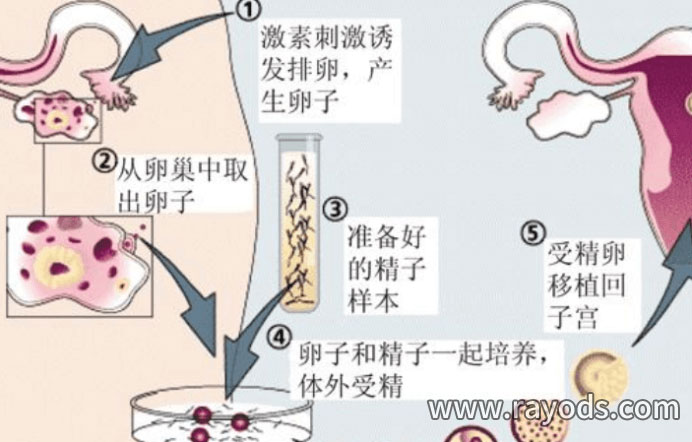 人工授精的费用是多少？有了这些选择，你就不会出错